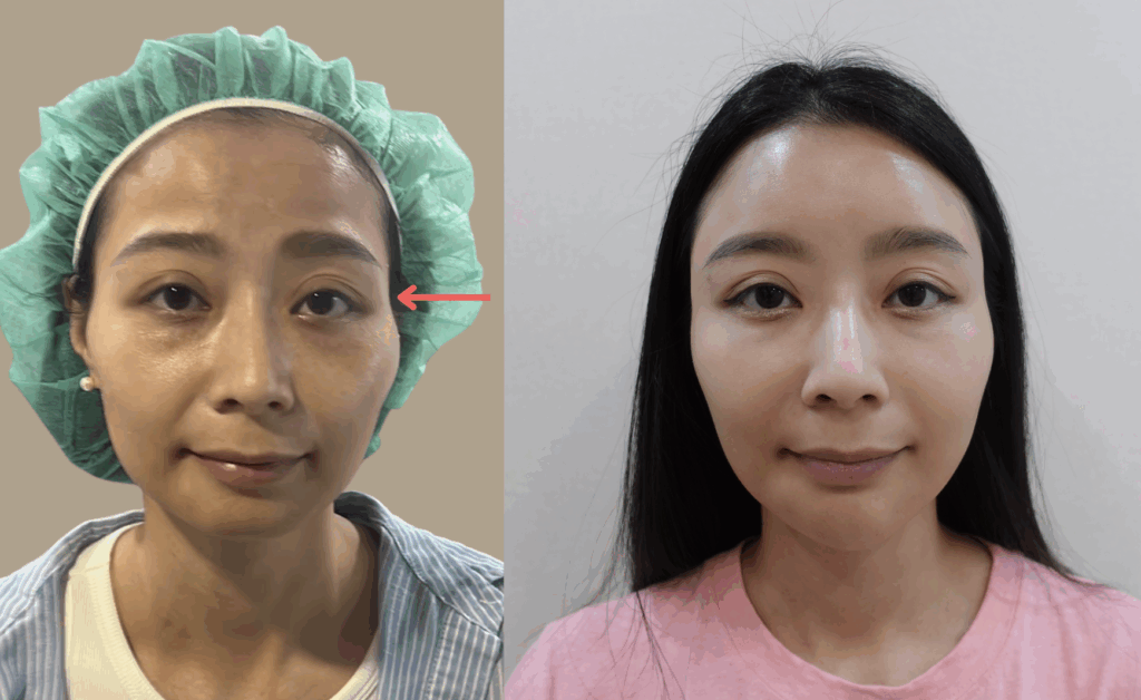 夫妻宮凹陷